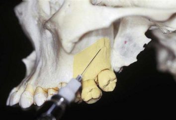 Posteriore blocco del nervo alveolare superiore in odontoiatria: elettrodomestici, farmaci