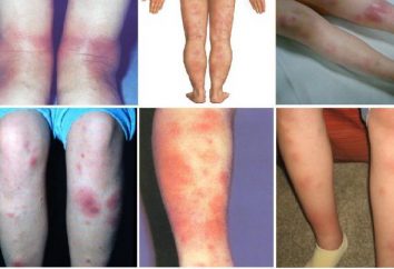 Eritema nodoso sulle gambe: sintomi, cause, trattamento