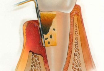 Parodontite cronica e acuta: sintomi, trattamento e cause