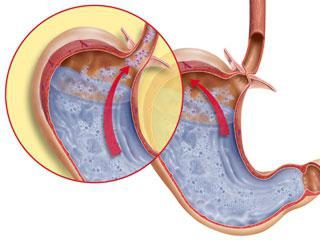 Casting di bile nello stomaco: cause, sintomi, il trattamento