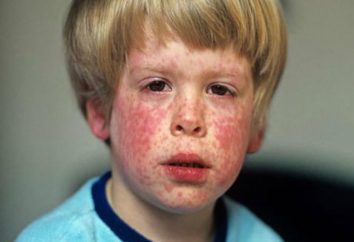 La rosolia – La rosolia è una malattia …: sintomi, il trattamento, le conseguenze e la prevenzione