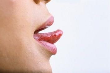 L'apparition d'une Pimple sur la langue: Causes et actions nécessaires