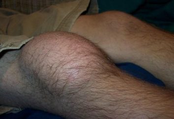 bursite Prepatellyarny du genou: symptômes et traitement