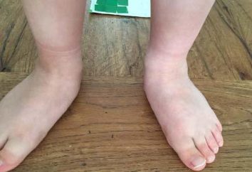 Koślawe stopy w niemowląt: przyczyny, leczenie. butów ortopedycznych dzieci