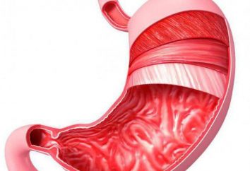 Atonia żołądka: przyczyny, objawy, diagnostyka i leczenie