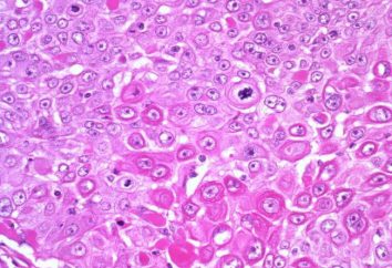 carcinome épidermoïde du col de l'utérus: le pronostic, le traitement