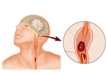 Ictus ischemico cerebrale: la prognosi per la vita. stroke riabilitazione