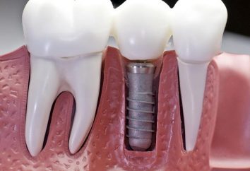 Os implantes dentários irá retornar ao seu ex-auto