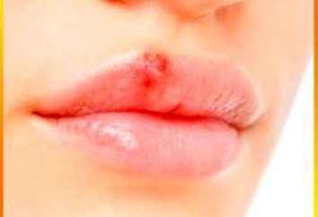 El herpes siniestro, o cómo tratar un resfriado en los labios