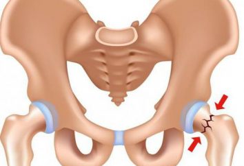 L'articulation de la hanche: un cassé et ses conséquences. remplacement de la hanche, la rééducation après chirurgie