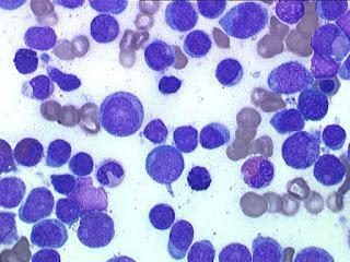 Leucocytose – quelle est cette maladie?