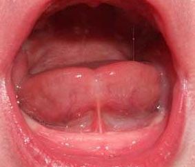 Un frenillo corto de la lengua en los niños es un problema que no se puede ejecutar