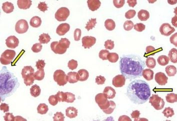 monocytes élevés dans le sang – qu'est-ce que cela signifie?