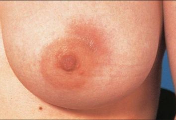 Przyczyny, objawy i symptomy zapalenia sutka u kobiet karmiących piersią