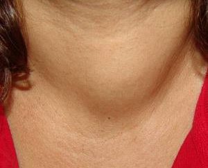 Problemi con la tiroide. I sintomi e metodi di trattamento