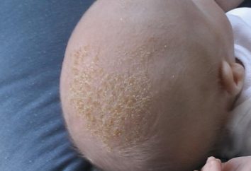 Krusten auf den Kopf eines Babys. Wie Sie Ihr Kind helfen?