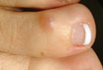 Como tratar milho seco no dedo do pé? O remendo de calos secos