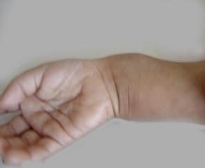 Rachitisme chez les enfants de moins d'un an: signes eabolevaniya