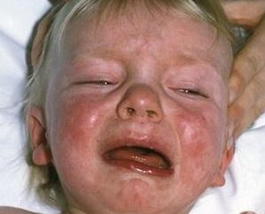 Die Reaktion auf den Impfstoff „Masern, Röteln, Mumps“ – die Gefahr eines realen oder einen Mythos?