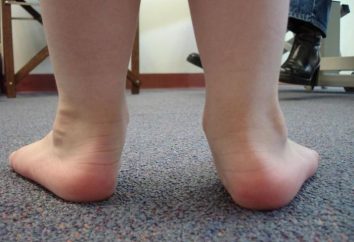 Ploskovalgusnye stopy dziecka. terapie