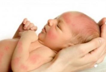 Le malattie più comuni della pelle del bambino