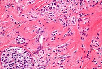 Rak – Co to jest? rak płaskonabłonkowy