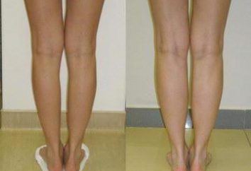 Korrigieren der Krümmung der Beine: moderne Methoden und Methoden