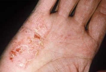 Como diagnosticar e tratar disgidroticheskuyu eczema?