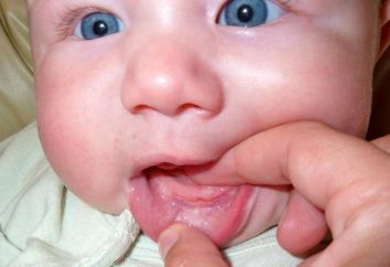 Macchie bianche sulle gengive nei neonati: cause, il trattamento