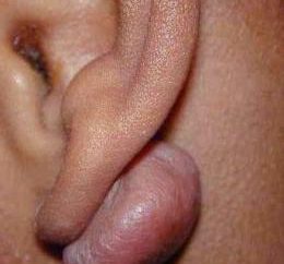 Il grumo dietro l'orecchio: che potrebbe essere così?