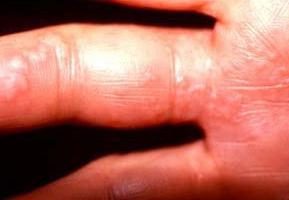 Herpes sulle mani (herpes whitlow): cause, sintomi, il trattamento