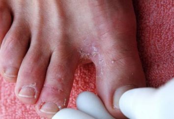 La grieta entre los dedos de los pies – ¿Qué hacer?