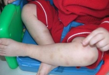 plaquetas aumentou na criança: o que poderia ser as razões?