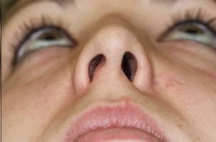 Curvatura della partizione nasale. Come restituire il soffio leggero?