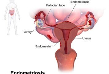 Spirale "Mirena" Endometriosi: recensioni