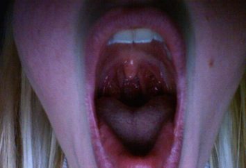 Malattie della gola: qual è la laringite?