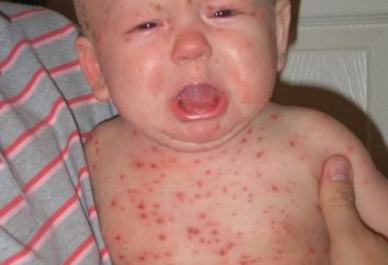 Come non farsi infettato da varicella per coloro per i quali è pericoloso. Posso ri-infettati con la varicella, e che cosa questo significa