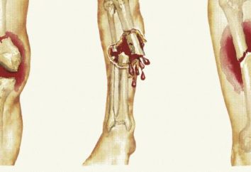Les fractures ouvertes et leur classification. Premiers secours pour les fractures ouvertes