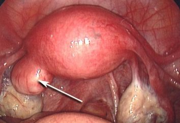 Endometrium polip: leczenie bez operacji i opinie