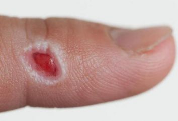 Granulację rany – co to jest? Gojenie granulacji